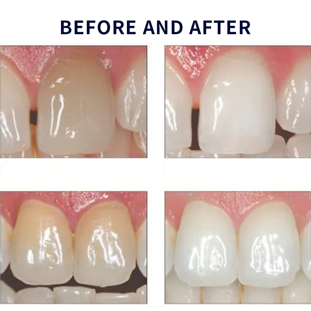 Отбеливающий набор opalution 2 – обзор и цена Teeth Whitening Doctor