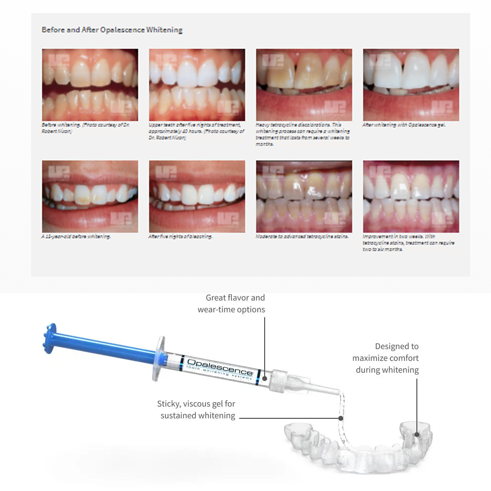 Отбеливающий набор opalution 2 – обзор и цена Teeth Whitening Doctor