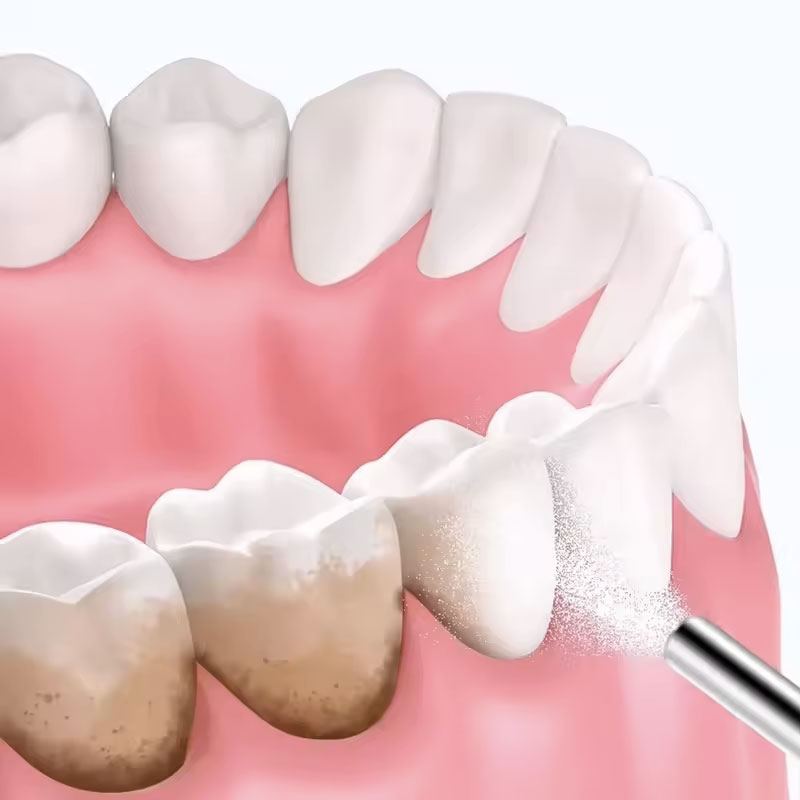 130 г порошка для пескоструйно – обзор и цена Teeth Whitening Zimba