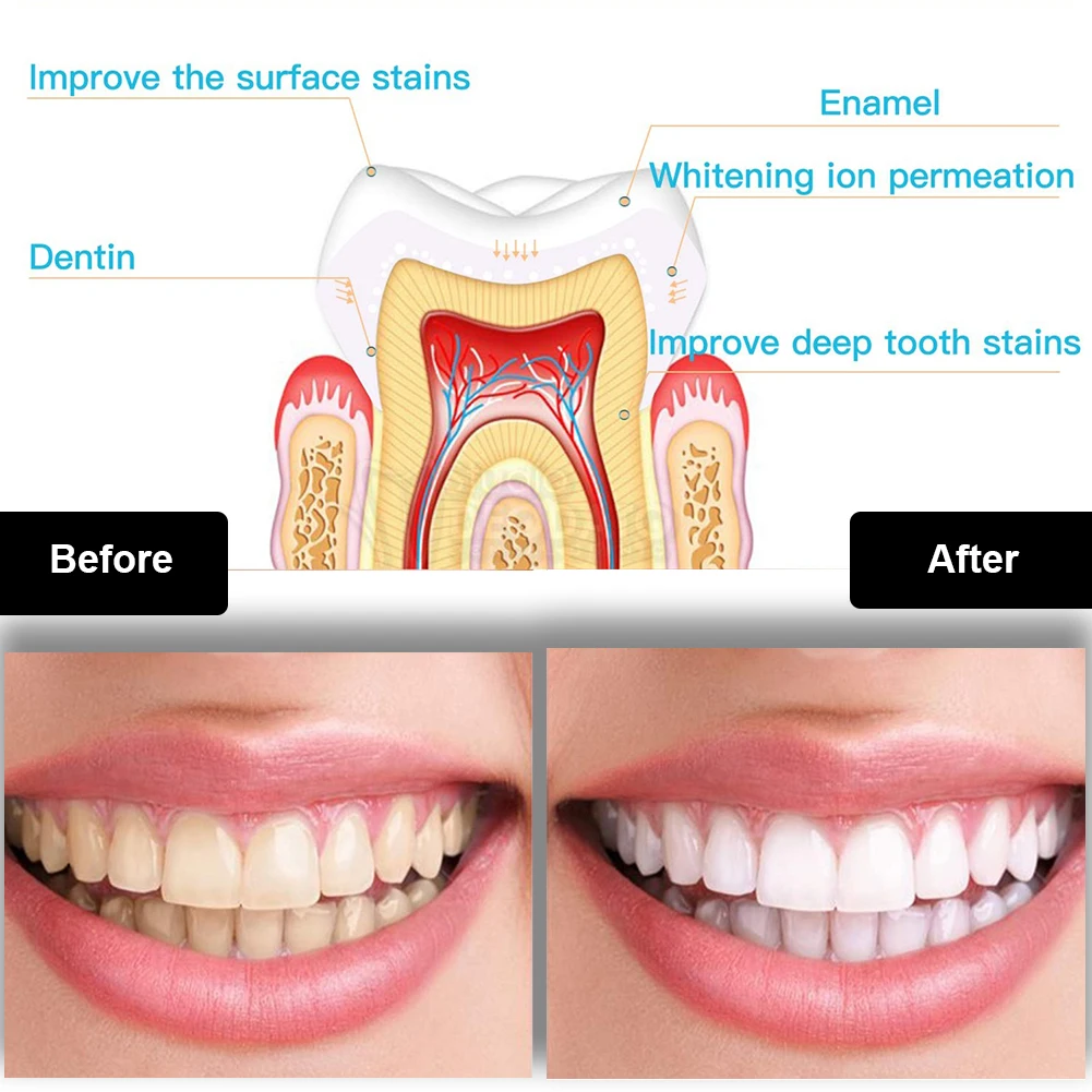 Набор для отбеливания зубов, м – обзор и цена Whitening Pen Bleach