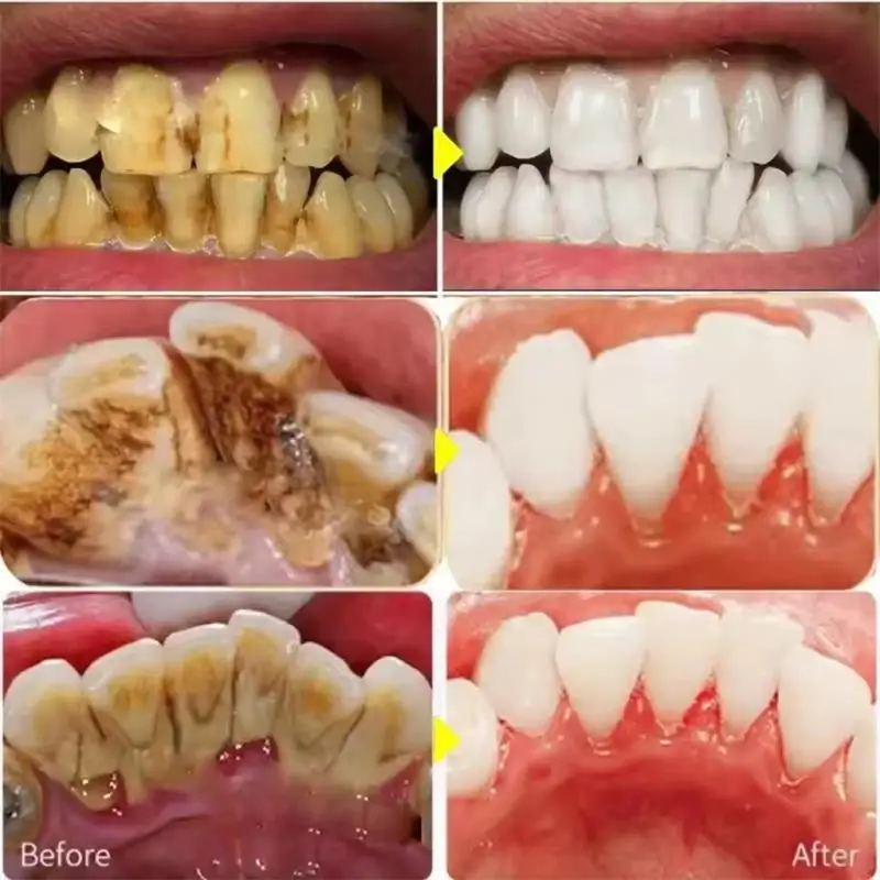 Зубная паста для быстрого отбе – обзор и цена Whitening Pen Bleach