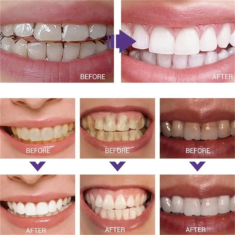 Зубная паста для быстрого отбе – обзор и цена Whitening Pen Bleach